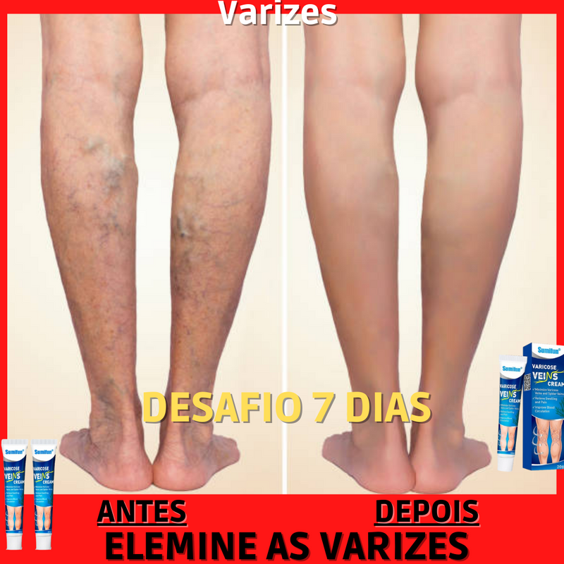 Creme Para Varicose Veins®